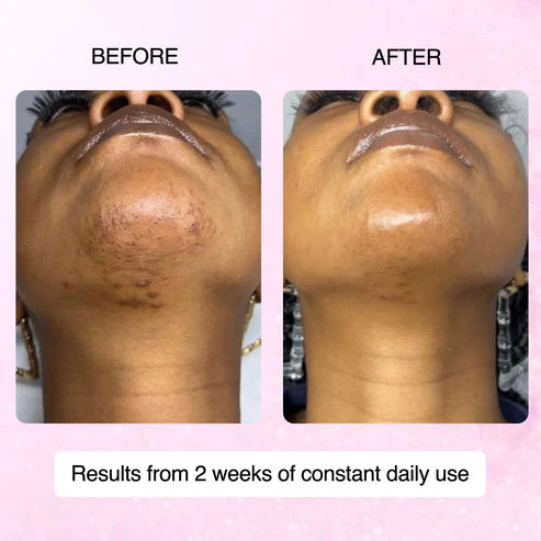 100% Natural Cyperus Rotundus Skin Serum